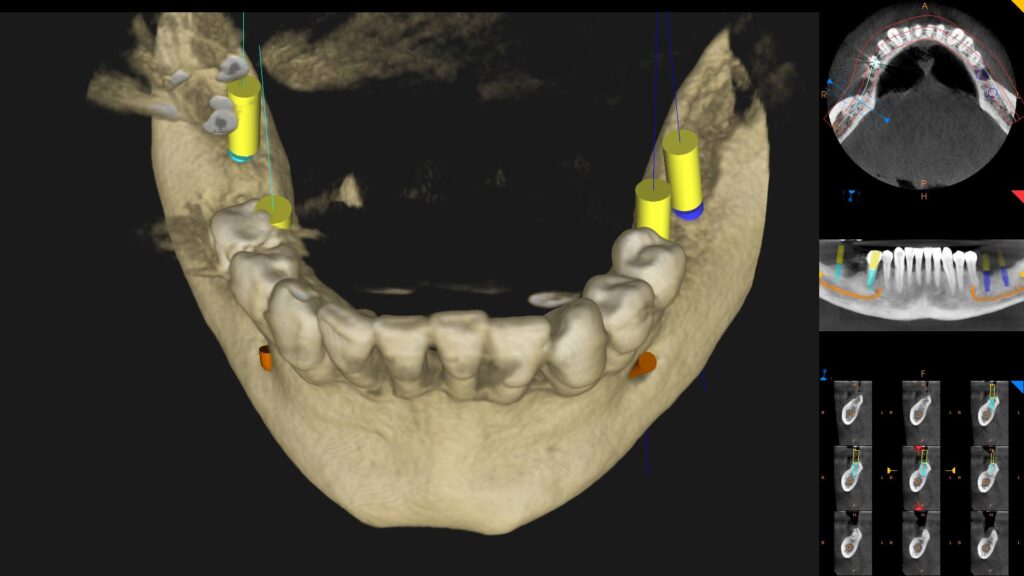 tecnologia CBCT està revolucionant l'odontologia